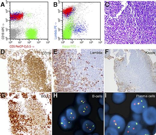 A 91-year-old woman was found to have bilateral cervical and right supraclavicular lymphadenopathy by computed tomography scan following an accident. There was no M-paraprotein in serum and there were no lytic bone lesions. Fine needle aspiration of the right cervical lymph node revealed admixture of small mature lymphoid cells and plasma cells (PCs) (not shown). Flow cytometry of fine needle aspiration showed CD5−/λ–restricted monotypic B cells (red, panels A-B) in the background of polytypic B cells (blue, panels A-B). Hematoxylin and eosin stain of the core biopsy (panel C) showed small lymphoid cells (panel C, right) and a sheet of PCs (panel C, left). The small lymphoid cells and PCs showed the following overlapping immunohistochemical profiles: CD19+/λ−/κ−/BCL-1+ and CD19+/λ+/κ−/BCL-1+, respectively (panels D, E, F, and G, respectively). Fluorescence in situ hybridization analysis using Vysis IGH/CCND1 XT dual-color dual-fusion probe showed rearrangement of BCL-1 (yellow) in both B cells (panel H) and PCs (panel I). Both monotypic lymphoid cells and PCs were negative for SOX-11 (not shown). / This is a unique case of CD5−/SOX-11− λ-restricted mantle cell lymphoma (MCL) with concomitant λ-restricted monotypic PCs. Only 3% to 4% of MCLs are negative for CD5, and monotypic plasmacytic differentiation in MCL is extremely rare. Absence of SOX-11 is consistent with the reported findings that knockdown of SOX-11 in MCL cells increased expression of plasma cell antigens.