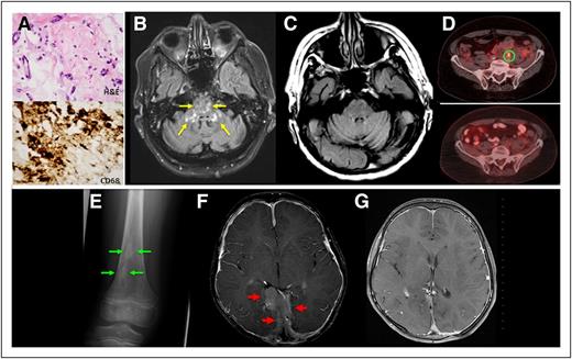 Figure 1. Perinephric tissue. Patient 1 with a CD68+ histiocytic infiltrate with admixed fibrosis (A). Axial T2-fluid attenuation inversion recovery MRI images demonstrate scattered lesions in the brainstem and cerebellar peduncles (yellow arrows) (B), and these are resolved after 6 months of treatment (C). A representative FDG-avid (SUV 3.1) periarterial lesion (D, upper) has resolved to background uptake (D, lower). Sclerotic lesions from the distal femur of patient 2 (E). Expansile meningeal infiltrations are demonstrated by axial postgadolinium T1-weighted MRI scan (red arrow) before treatment (F) and then are resolved 2 years into anakinra therapy (G).