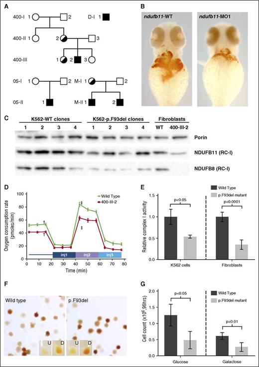 Figure 1. NDUFB11 mutations in CSA. (A) NDUFB11 CSA pedigrees. Black shading indicates the genotype. The genotype of M-I-1 is inferred on the basis of her 2 sons. (B) Zebrafish embryos stained for hemoglobin with o-dianisidine at 48 hours postfertilization (hpf) following microinjection with water control or antisense morpholino reagents targeting the fish ortholog of human NDUFB11. (C) Total mitochondrial protein was analyzed for the RC-I proteins NDUFB11 (middle) and NDUFB8 (bottom) in K562 cells and patient fibroblasts by western blot. Equivalent loading of mitochondrial lysates was confirmed by immunoblot analysis for porin (VDAC1) (top). (D) Mitochondrial function was measured using oxygen consumption rate (ocr) using the Seahorse Mitostress test. Patient and control fibroblasts were treated with 2 µM oligomycin injection 1 (inj1), 0.5 µM carbonyl cyanide-4-(trifluoromethoxy) phenylhydrazone (FCCP) (inj2), and 1 µM rotenone/antimycin A (inj3). Error bars are ± standard error of the mean (SEM). Basal OCR was measured before adding treatments (†) and maximum OCR was measured after the addition of 0.5 µM FCCP (‡). The difference in basal and maximum OCR is plotted in supplemental Figure 6. (E) RC-I function was analyzed in K562 cell lines (n = 4, clones as in panel C) and control and patient fibroblasts (n = 6, technical replicates) and normalized to citrate synthase activity. Data are expressed relative to the wild-type (WT) value, whose mean was defined as 1.0. Ratios are ± standard deviation (SD). (F) Representative WT and p.F93del K562 cells (clones K562-WT3 and K562-p.F93del1) stained with o-dianisidine show normal hemoglobinization. Undifferentiated (U) and differentiated (D) K562 cells cultured in the presence of 6.0 mM sodium butyrate for differentiation. (G) Growth of undifferentiated K562 cells (n = 4 clones) in glucose or galactose after 96 hours. Cells were initially plated at 4 × 104 cells per mL and analyzed in triplicate.