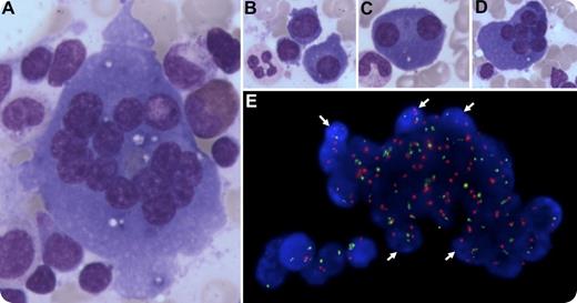 A 64-year-old man with immunoglobulin A κ multiple myeloma was treated initially with bortezomib, thalidomide, dexamethasone, and daratumumab, an anti-CD38 antibody. After 4 cycles, the monoclonal component had decreased from 27 g/L to 8 g/L. A bone marrow aspirate was performed. Our attention was caught by large multinucleated cells with basophilic cytoplasm (panel A; original magnification ×400, May Grünwald Giemsa stain) that could be identified at first as osteoclasts or dystrophic megakaryocytes. However, there was a continuum between dystrophic plasmocytes with 1, 2, or more nuclei and these giant multinucleated cells (panels B-D; original magnification ×200 for each panel, May Grünwald Giemsa stain). Using fluorescent in situ hybridization (red, chromosome 4; green, chromosome 14) and staining of the nuclei with 4′,6-diamidino-2-phenylindole (DAPI), we found that the nuclei of these cells harbored the cytogenetic abnormality observed at diagnosis (ie, a trisomy of chromosome 4; panel E, original magnification ×630, white arrows), confirming that they were indeed myelomatous polykaryons. Of note, these images were not seen on review of the diagnostic bone marrow. / Most of the time, multinucleated cells observed on a bone marrow smear are physiological, resulting from endomitosis (eg, megakaryocytes) or from fusion of mononucleated cells (eg, osteoclasts). However, one should keep in mind that multinucleated cells can also be part of a neoplastic process such as multiple myeloma. Although binucleated plasmocytes can be observed in healthy individuals, multinucleated plasmocytes must be considered as pathological.