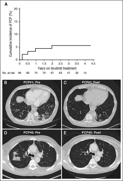 Figure 1. Estimated cumulative incidence rate and radiologic presentation of P jirovecii in a CLL patient treated with ibrutinib. (A) The estimated cumulative incidence of PCP in CLL is 4.5% at 1 year on ibrutinib, and 5.6% at 2 years and thereafter. The cumulative incidence of PCP was estimated by considering deaths or early discontinuation of ibrutinib without PCP as competing risk events; otherwise, patients on ibrutinib treatment were censored at the last follow up if no PCP was observed.11 (B-E) Chest CT images of 2 patients are shown who were diagnosed with and treated for PCP while on ibrutinib. The first patient presented with multifocal ground-glass opacificies (B), which significantly improved after treatment of PCP (C). The second patient presented with unilateral nodular infiltrates (D), which resolved after treatment (E).