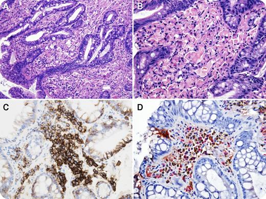 An 80-year-old man presented with chronic pain in the epigastrium. An upper gastrointestinal endoscopy with esophageal biopsy was performed. Histopathologic sections showed Barrett’s mucosa (panel A; original magnification ×20, hematoxylin and eosin stain) with marked plasmacytic infiltrate laden with numerous Russell bodies in the lamina propria (panel B; original magnification ×40, hematoxylin and eosin stain). Helicobacter pylori immunostain was negative. Immunohistochemical stain for CD138 was positive in the plasma cells (panel C; original magnification ×40). Dual immunohistochemical stain for κ and λ showed a polytypic immunoglobulin light chain pattern (panel D; original magnification ×40). Congo red stain for amyloid was negative. CD20-positive B cells and a few scattered CD3-positive T cells were seen. The overall morphology and immunophenotype were consistent with the diagnosis of Mott cell (Russell body) Barrett's esophagitis. / Russell body gastroenteritis is an incidental and rare chronic inflammatory condition, characterized by abundant intramucosal polyclonal plasma cells, and has been reported in association with Barrett’s esophagus, H pylori infection, HIV, gastric carcinoma, monoclonal gammopathy, and hepatitis C. Overstimulation of plasma cells leads to accumulation of nondegradable immunoglobulin in dilated rough endoplasmic reticulum cisternae, which is seen as Russell bodies. It is important to recognize this unusual pattern of inflammation and do a complete workup to exclude all the above conditions. Also, this entity can sometimes be confused with extranodal marginal zone lymphoma of mucosa-associated lymphoid tissue, plasmacytoma, and signet ring cell carcinoma.