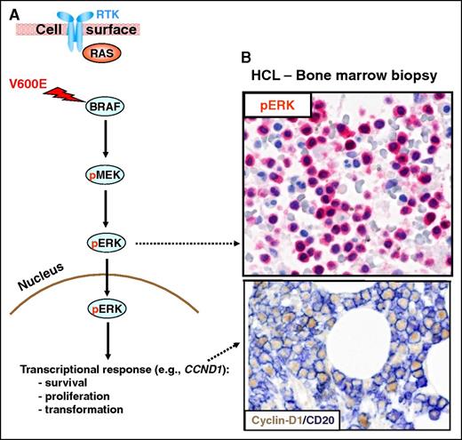 Figure 1. The RAS-RAF-MEK-ERK signaling pathway. (A) The RAS-RAF-MEK-ERK signaling pathway is physiologically triggered by the binding of a surface receptor tyrosine kinase (RTK) to its ligand. This activates RAS and, in turn, RAFs (BRAF and, not shown, CRAF). BRAF-CRAF heterodimers phosphorylate the MEK1 and MEK2 kinases (pMEK), which in turn phosphorylate ERK1 and ERK2 (pERK). Then, active ERKs phosphorylate several substrates in the cytoplasm (not shown) as well as in the nucleus, where they initiate a transcriptional response (eg, through the activator protein 1 transcription complex) that includes cyclin-D1 upregulation and that promotes cell survival and proliferation, as well as feedback inhibitory mechanisms (not shown) to counterregulate pathway activity. The latter, if uncontrolled, can result in neoplastic transformation. Indeed, the BRAF V600E mutation renders BRAF constitutively active independent from upstream regulatory signals and from heterodimerization with CRAF. (B) In vivo activation of the BRAF-MEK-ERK pathway in HCL patients is illustrated by the expression of pERK (red) and cyclin-D1 (nuclear, brown) by BM leukemic hairy cells (counterstained with hematoxylin in the top panel and double stained for the surface B-cell marker CD20 (surface, blue) in the bottom panel). Pictures of immunohistochemical stainings were taken with the 40×/0.85 objective (U Plan Apo) of a BX61 microscope equipped with a DP71 digital camera, using cell^B x.y acquisition software (all from Olympus).