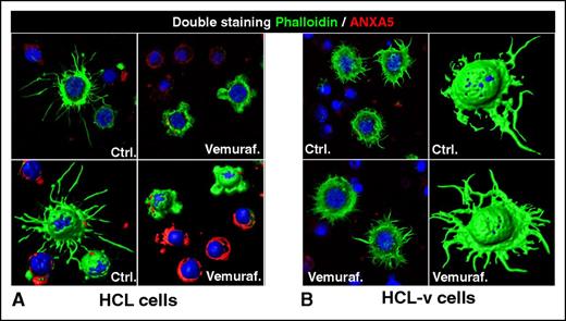 Figure 2. Loss of the hairy morphology upon BRAF inhibition. Leukemic cells purified from patients with (A) HCL or (B) HCL-v were exposed in vitro to vemurafenib (vemuraf.) 1 µM or drug vehicle as control (Ctrl.) for 2 or 3 days, and then costained with phalloidin (labeling in green the cytoskeleton of hairy projections rich in F-actin), Annexin-V (ANXA5, labeling in red the dying cells), and Draq5 (labeling the nucleus), followed by confocal fluorescence microscopy showing 2-dimensional images of representative cells and their corresponding 3-dimensional reconstruction. After blocking BRAF V600E with vemurafenib, HCL (but not HCL-v) cells become smoother and smaller while being still alive (ANXA5− HCL cells showing severely shortened green surface projections). This hair loss is then followed by apoptosis of HCL (but not HCL-v) cells, which become ANXA5+ (red) and lose any phalloidin-positive (green) cytoskeletal structures. These images were taken with a LSM510 laser-scanning confocal microscope (Zeiss) equipped with laser emission lines at 458, 488, 543, and 633 nm, using an objective Plan-Apocromat 63×/1.4 NA with oil immersion and LSM510 Zeiss software.