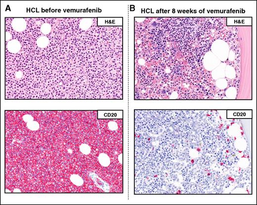 Figure 4. Example of a complete remission obtained with vemurafenib in relapsed/refractory HCL. The BM biopsies of a patient with multiple HCL relapses is shown (A) before and (B) after 8 weeks of treatment with vemurafenib. H&E (top panels) and CD20 (red; bottom panels) stainings show a massive leukemic infiltration which is largely cleared by vemurafenib (<10% residual HCL cells posttherapy). Pictures of immunohistochemical stainings were taken with the 40×/0.85 objective (U Plan Apo) of a BX61 microscope equipped with a DP71 digital camera, using cell^B x.y acquisition software (all from Olympus).