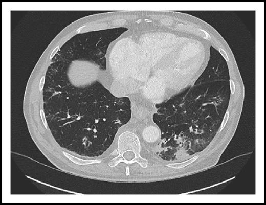 CT scan of the chest from a patient on ibrutinib monotherapy showing interstitial (ground glass) pulmonary infiltrates caused by Pneumocystis pneumonia. See the complete Figure 1 in the article by Ahn et al that begins on page 1940.
