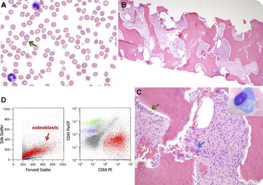 A 33-year-old African American man with end-stage renal disease on hemodialysis for 5 years presented with anemia and splenomegaly. His peripheral blood smear demonstrated anemia (hemoglobin 77 g/L) with anisopoikilocytosis including occasional teardrop cells (panel A, green arrow). Bone marrow (BM) core biopsy revealed a hypocellular marrow with trilineage hypoplasia (panel B), osteosclerosis with increased osteoblasts (panel C, green arrow/inset) and osteoclasts (blue arrow), and grade 3 myelofibrosis (with reticulin and collagen fibrosis). There was no evidence for a myeloproliferative neoplasm (MPN) or metastatic tumor. Cytogenetic/molecular studies for JAK2 V617F, MPL mutations, and BCR/ABL1 rearrangement were normal. Flow cytometric analysis (FCA) on the BM biopsy revealed CD56+/CD45− osteoblasts (panel D, red arrow; events in blue and green represent hematogones and T cells, respectively). The parathyroid hormone level was significantly increased (3295 pg/mL; reference range, 15-65 pg/mL). The overall findings were diagnostic of nonneoplastic myelofibrosis resulting from secondary hyperparathyroidism in a patient with long-standing end-stage renal disease. / Myelofibrosis secondary to renal osteodystrophy is an uncommon disease and has been rarely reported. Recognition of its histologic features is important in the differential diagnosis of a fibrotic BM (in particular, MPNs). Furthermore, the presence of CD56+/CD45− cells by FCA may be mistaken for evidence of a metastatic tumor. Comprehensive analysis is instrumental for an accurate diagnosis.