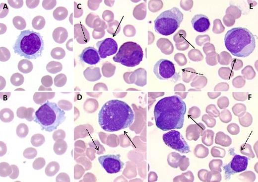An 82-year-old man without history of hematologic or malignant disorders was admitted for fatigue. The complete blood count showed bicytopenia: a macrocytic anemia (10.6 g/dL, 101.3 fL, and 33 × 109/L reticulocytes), leukopenia (2 × 109/L) with neutropenia (0.2 × 109/L), monocytopenia (0.04 × 109/L), and 171 × 109/L platelets. The peripheral smear showed 8% small- to medium-sized hairy lymphocytes with an oval nucleus and pale blue cytoplasm (panels A-B) highly suggestive of hairy cell leukemia. Immunophenotyping of peripheral blood (PB) showed 11% κ-restricted B lymphocytes expressing CD11c but lacking CD24, CD25, CD103, and CD123, consistent with a splenic marginal zone lymphoma. Indeed, the bone marrow (BM) smear showed 10.5% abnormal lymphocytes, with a villous (not hairy cell) morphology (panels C-F, dotted arrows) and the same immunophenotype as the PB cells. The BM had decreased cellularity, with 20% blasts present (panels C-F, full arrows) together with maturing cells of the neutrophil lineage and dyserythropoiesis. Cytochemistry confirmed the positivity of blasts for myeloperoxidase, leading to the diagnosis of acute myeloid leukemia. / Conventional cytogenetics of the myeloid blasts detected a complex karyotype with del(5q). Treatment with azacytidine was started. This observation of cytopenia led to the rare and unexpected diagnosis of 2 hematologic neoplasms: splenic marginal zone lymphoma and acute myeloid leukemia with maturation.