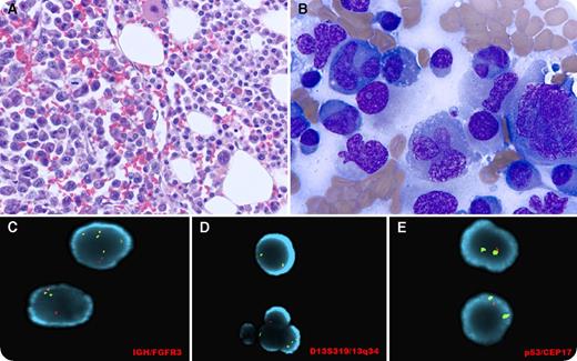 A 59-year-old hypertensive and diabetic man presented with bone pain, oliguria, and abdominal pain. Blood tests showed: hemoglobin, 8.7 g/dL; platelets, 69 × 109/L; β-2 microglobulin, 54.23 nmol/L; serum IgA, 3450 mg/L; free λ light chain, 8570 mg/L; serum calcium, 4.05 mmol/L; blood urea nitrogen, 24.28 mmol/L; and creatinine, 526.86 μmol/L. Imaging showed innumerable lytic lesions in the calvarium and a T7 vertebral body mass with extraosseous extension. Marrow biopsy showed sheets of abnormal plasma cells, with zones of pleomorphic, multinucleated cells alternating with more uniform malignant plasma cells (panels A-B; hematoxylin and eosin and Diff-Quik stains, respectively; original magnification ×1000), both λ-restricted by in situ hybridization. Fluorescence in situ hybridization showed del(17p13)(p53) (88% of cells), IGH/FGFR3 rearrangement (69% of cells), and del(13q14.3) (58% of cells) (panels C-E; original magnification ×1000). Karyotyping revealed multiple abnormalities including t(1;19), chromosome 13 abnormalities, add(1)(q21), and near tetraploidy in 75% of the cells analyzed. The patient was treated with cyclophosphamide, bortezomib, and dexamethasone, and the follow-up free λ light chain after 3 months was 147.7 mg/L. / Anaplastic myeloma is a rare, treatment-resistant subtype with poor prognosis. It is more common in younger patients, associated with immunoglobulin A isotype, predisposition for the extramedullary sites, and with 1q21 amplification, 17p(p53) deletion, t(4;14), and/or chromosome 13 anomalies. Anaplastic morphology may present initially or as a feature of progression.