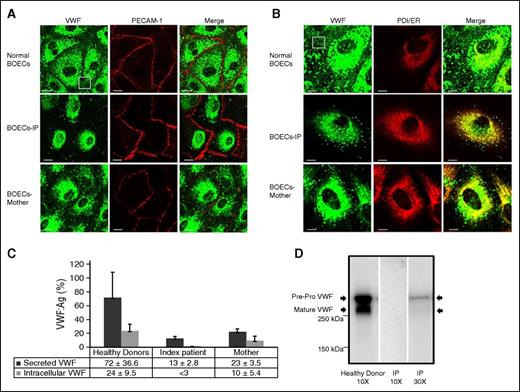Figure 2. Subcellular distribution and expression of VWF in the BOECs isolated from the IP and healthy donors. (A) Characteristics of the BOECs via staining of the cell-specific markers VWF (light green) and PECAM (red) with secondary antibodies conjugated with Alexa Fluor-488 and Alexa Fluor-594, respectively. However, only 64 of 100 inspected IP BOECs emitted light green fluorescent signals, representing production of VWF protein. In the VWF-expressing IP BOECs, VWF staining is mostly diffuse, accumulating around the nucleus of the cells, whereas in normal BOECs, VWF can be seen as distinct elongated structures, indicating storage in WPBs. The BOECs isolated from the IP’s mother illustrate a combination of VWF stored in WPBs and diffuse staining. The white box points out secreting VWF strings in normal BOECs that are not visible in the IP-derived BOECs. Bars represent 20 µm. (B) Diffuse staining observed in BOECs obtained from the IP and her mother (carrying the mutation c. 7464C>T) was colocalized with protein disulfide isomerase (PDI). Staining was performed using primary antibodies anti-VWF (left channel, light green) and anti-PDI (ER marker; middle, red) and secondary antibodies conjugated with Alexa Fluor-488 and Alexa Fluor-555, respectively. Colocalization of VWF and PDI staining is illustrated in the right channel (Merge). Bars represent 10 µm. (C) Bar graph of the mean of VWF:Ag levels in the medium and lysates of BOECs obtained from the IP, her mother (3 independent experiments, N = 3), and 3 healthy donors (each 3 independent experiments, N = 9). The mean VWF:Ag was determined after 10× concentration of the collected medium and cell lysates of confluent BOECs in 75 cm2 flasks. Error bars indicate the standard deviation. (D) Western blot analysis of BOEC intracellular VWF after electrophoresis on 4% to 15% sodium dodecyl sulfate–polyacrylamide gel electrophoresis. Left lane shows both pre-pro-VWF and mature VWF in the lysate of the normal BOECs after 10× concentration. Middle and right lanes are representative of the IP’s BOEC lysates after 10× and 30× concentrations, respectively. WPBs, Weibel-Palade bodies.