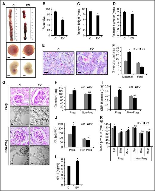 Figure 1. EVs impair embryonic and placental development and cause a PE-like phenotype in mice. (A-D) Impaired pregnancy outcome in C57BL/6 mice at day 12.5 p.c. following IV injection of mouse endothelial cell–derived EVs at days 10.5 p.c. and 11.5 p.c. Representative images (A) of uterus (top), placenta (middle), and embryo (bottom) and bar graphs quantifying (B) embryonic survival, (C) embryonic height, and (D) placental diameter. Size bar represents 1 mm. (E-F) Altered placental morphology after EV injections. (E) Representative images of placental histology (H&E staining) showing enhanced maternal vascularization (blood lacunae; enucleated erythrocytes) and reduced fetal vascularization (nucleated erythrocytes) after EV injections. (F) Bar graph summarizing quantification of total vascularized area; analyses performed at day 12.5 p.c. Size bar represents 20 µm. (G-L) Characterization of renal pathology in pregnant (Preg) and nonpregnant (Non-Preg) mice following EV injection. Representative images showing enhanced renal pathology in pregnant mice after EV injections, characterized by enlarged glomeruli (G, PAS staining, top; H, bar graph reflecting quantification) and podocyte effacement and thickened glomerular basement membrane (GBM) (G, TEM, n = 3, bottom; I, bar graph reflecting glomerular basement membrane thickness). Proteinuria is increased in EV-injected pregnant mothers at day 12.5 p.c. (J, bar graph summarizing data of P/C ratio). These features of renal dysfunction are not observed in EV-injected nonpregnant females. Size bar represents 15 µm for PAS staining and 1 µm for TEM images, respectively. (K) Elevated blood pressure in EV-injected pregnant mice at day 12.5 p.c. EVs have no impact on blood pressure in nonpregnant mice; bar graph summarizing results. (L) sFlt-1 plasma levels. The PE marker sFlt-1 is increased in blood samples obtained from EV-injected pregnant mice as compared with controls (bar graph summarizing results). Data shown represent mean ± SEM of at least 8 placentae or embryos analyzed from at least 3 different litters of each group or 5 pregnant females per group. Control mice (C) were injected with the supernatant obtained after the last PBS wash during EV isolation. *P < .05, **P < .01. (B-D, H-K) Student t test; (F) ANOVA. Dias, diastolic; ns, nonsignificant; Sys, systolic.
