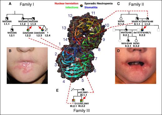 Figure 1. Pedigrees of families. (A) Family I. The 2 probands (I.2.2 and I.2.3 indicated by red arrows) were studied on several occasions with reproducible neutrophil abnormalities measured. The deceased twin I.2.4 is presumed to have been affected. The probands are homozygous for D26N. No abnormalities were noted in the neutrophils of the heterozygous parents, brother, or maternal uncle. Clinical features of affected individuals are designated by the 4-color filled symbol at the top. Heterozygous carriers are indicated by diagonally filled symbols. Wild-type individuals are indicated by open symbols. Open symbols in gray represent untested family members. A symbol with a diagonal line indicates a deceased family member. (B) Stomatitis with severe oral stenosis in patient I.2.3. (C) Family II. Patient II.2.2 was originally reported in 1978,10 at which time many studies were performed as reported. Because no DNA from her was recoverable, her genotype was inferred from her parents and sibling. She is presumed to have been compound heterozygous for delK7 and V424M. (D) Stomatitis in patient II.2.2. (E) Family 3. Patient III.2.2 was compound heterozygous for L286V and G121R, which are presumed to reside on different alleles by virtue of only 1 allele being found in the mother. The clinically affected brother, III.2.1, was not available for genetic study. (F) Molecular modeling of human Aip1 based on S cerevisiae Aip1/UNC78 shows a dual β-propeller, comprised of an N-terminal propeller (lower) and a C-terminal propeller (upper). Each propeller consists of 7 blades, labeled 1 to 7 in the N-terminal propeller and 8 to 14 in the C-terminal peptide. Each blade consists of a twisted β-sheet comprised of 4 antiparallel strands (A-D). The N terminus of the peptide (shown in blue) traverses the hinge region and forms the D strand of blade 14 (shown in red), conferring rigidity to the open “clamshell” structure. Each of the mutations identified have been superimposed on the images.
