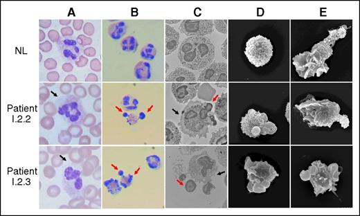 Figure 2. Morphology of neutrophils. (A) Neutrophils from whole blood smears of a normal subject (NL, top row) and patients I.2.2 (middle row) and I.2.3 (bottom row) stained with Diff-Quik. The black arrows indicate regions of abnormally agranular cytoplasm. (B) Neutrophils prepared by Ficoll centrifugation, 3% dextran sedimentation, and sequential erythrocyte hypotonic lysis. Neutrophils were centrifuged onto slides at 100g for 10 minutes and then stained. Red arrows indicate herniated nuclear lobes. (C) Transmission electron micrographs of isolated neutrophils. Black arrows indicate areas of abnormally agranular cytoplasm; red arrows indicate herniated nuclear lobes. Overall, 40% to 60% of patient cells had abnormal morphology. (D) Scanning electron micrographs of isolated neutrophils, showing knob-like projections on patient neutrophils (magnification, ×6000). (E) Scanning electron micrographs of isolated neutrophils. Stimulation of normal cells with fMLF resulted in polarization with elongation of the cells with protruding lamellipodia and trailing uropod. Although neutrophils from patients I.2.2 and I.2.3 underwent some morphology change, they failed to exhibit the morphological changes of normal subjects.