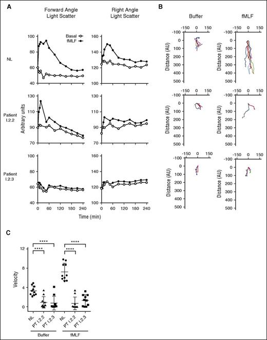 Figure 3. Patient neutrophil dysfunction. (A) (Left column) Temporal changes in forward angle light scatter (polarization) in normal neutrophils and neutrophils from patients I.2.2 and I.2.3 after treatment with buffer or fMLF (1 × 10−7 M). (Right column) Similar time course of changes in right angle light scatter (membrane ruffling). In B, neutrophils (1 μL of 2 × 106 cells/mL in HBSS with divalent cations) were added to the “Cell” well of EZ-TAXIScan and either buffer or fMLF was added to the “Chemoattractant” well. The cells were incubated for 60 minutes, and images were collected every 2.5 minutes. Ten randomly chosen cells were electronically traced using the acquired images and the paths of the cells plotted with the position at t = 0 anchored at the origin. (Left column) Random migration of neutrophils from a normal subject and from patients I.2.2 and I.2.3. (Right column) Directed migration in response to fMLF (1 × 10−8 M). (C) Scattergrams of the average velocities of the individual cells that were tracked in B. Note that the cells from both patients have a significant defect (analysis of variance, ****P < .001) in both their basal migration and a defect in their migration to the chemoattractant, fMLF.