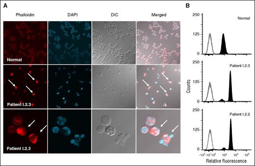 Figure 4. Abnormal neutrophil morphology and association with increased microfilaments. (A) Neutrophils from a normal subject (top row) and patient I.2.3 (middle row) were stained for F-actin (Alex Fluor 546 phalloidin), and the nuclei were stained with 4',6-diamidino-2-phenylindole. Fluorescence and differential interference contrast images are shown individually and merged. Neutrophils with herniated nuclear lobes are indicated by white arrows in the phalloidin-stained and merged images of patient I.2.3. A higher magnification (×1000) of neutrophils from patient I.2.3 is presented in the bottom row. (B) Neutrophil flow cytometric phalloidin staining. Unstained cells are shown in gray outline, whereas F-actin–containing cells labeled with Alex Fluor 546 phalloidin are shown in solid dark.