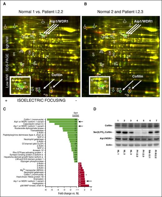 Figure 5. Two-dimensional differential in-gel electrophoresis of neutrophil lysates. (A) Lysates of normal and patient I.2.2 neutrophils were differentially labeled (with Cy3, green, and Cy5, red, respectively) and mixed together, and the proteins were resolved by 2D gel electrophoresis (isoelectric focusing horizontally, and SDS-PAGE vertically). The protein spots on the resolved proteins gels were imaged for the red and green dye fluorescence, respectively, and then the ratios of the images were determined. Green spots indicate increased protein expression in the lysate of neutrophils from the normal subject compared with the lysate from neutrophils of patient I.2.2; similarly, red spots indicate increased protein expression in the lysate of neutrophils from patient I.2.2. Convergence of spots resulting in yellow indicated equivalent protein expression in the lysates of neutrophils from both subjects. The spots that were differentially expressed are indicated by circles and identified by numbers. The identity of these differentially expressed spots was excised and determined by mass spectrometry. The inset is an enlargement of the region where Aip1 migrated. (B) Same analysis for normal compared with patient I.2.3. (C) Relative changes in the mean (normal vs patient) expression of proteins in neutrophil lysates. The number in each bar refers to the specific spot on the 2D gel. Note that both cofilin (*) and AIP1 (arrows) are represented in multiple spots. (D) Protein expression in neutrophil lysates from 3 normal subjects, patients I.2.2 and I.2.3, and their unaffected heterozygous sibling, I.2.1, and patient III.2.2 of family III. The immunoblots were probed with antibodies to Aip1, cofilin, phospho-cofilin Ser(3), and actin as indicated.