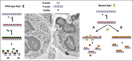 Figure 6. Proposed consequence of mutated Aip1. Neutrophil migration and spreading requires dynamic polymerization/depolymerization of the cytoskeletal actin, altering the fluidity of the cytosol (gel↔sol transformations) and promoting changes in cellular morphology. Aip1 is thought to bind to cofilin and enhance its actin depolymerizing activity. Mutations affecting Aip1 either disrupt its interactions with cofilin (failure to enhance its activity), promoting the accumulation of F-actin and disrupting the cytoskeletal organization of the cytosol.