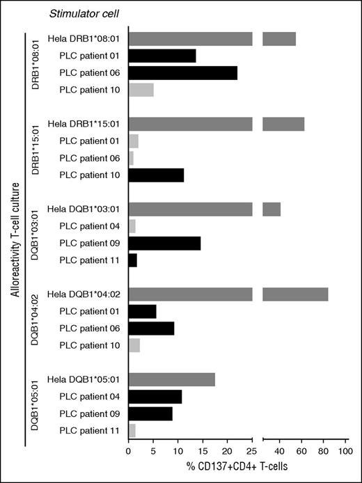 Figure 5. Anti-HLA class II allele-specific immune reactivity in early post-dUCBT PB samples contributes to antileukemic cell reactivity. Post-dUCBT patient PBMC samples were propagated on HeLa cells transduced with mismatched HLA class II alleles of the nonengrafting CBU as specified in Figure 2A. T-cell cultures (n = 5) with proven HLA class II alloreactivity toward DRB1*08:01 (derived from patient 4), DRB1*15:01 (patient 11), DQB1*03:01 (patient 10), DQB1*04:02 (patient 4), and DQB1*05:01 (patient 2) were tested for reactivity toward the corresponding HLA class II molecule expressing HeLa and toward PLCs obtained from 6 patients, ie, patient 1 (DRB1*08:01, DQB1*04:02), patient 4 (DQB1*05:01), patient 6 (DRB1*08:01, DQB1*04:02), patient 9 (DQB1*03:01, DQB1*05:01), patient 10 (DRB1*15:01), and patient 11 (DRB1*11:01, DQB1*03:01). Complete HLA class II typing of the patients is presented in Table 3. x-axis: net % CD137 upregulation, ie, %CD137 upregulation on alloreactive CD4+ T cells following coculture with HLA class II–expressing HeLa cells or PLCs minus reactivity toward the empty HeLa cell (positive response: net CD137 upregulation >5%); y-axis: stimulator cells (Hela or PLC) per alloreactivity of the tested T-cell culture. Dark gray bar: positive control, HLA class II alloreactive T-cell culture with the corresponding HLA class II allele transduced HeLa cell; black bar: HLA class II alloreactive T-cell culture with PLCs expressing the corresponding HLA class II allele; light gray bar: HLA class II alloreactive T-cell culture with PLCs not expressing the corresponding HLA class II allele.