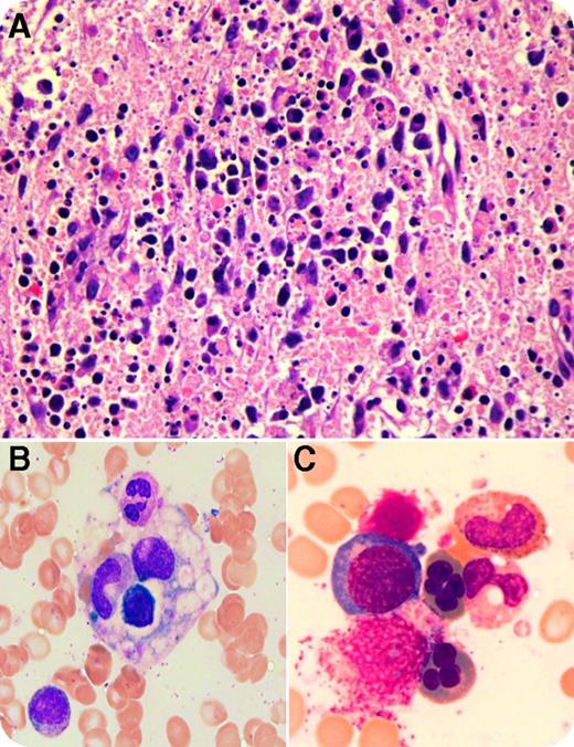 A 37-year-old man of Pakistani origin presented with a 5-week history of fever, night sweats, fatigue, nausea, vomiting, lymphadenopathy, and splenomegaly. He had similar symptoms 5 years prior with a cervical lymph node (LN) biopsy showing histiocytic necrotizing lymphadenitis or Kikuchi disease (KD). He had pancytopenia, with a neutrophil count of 0.52 × 109/L, hemoglobin count of 76 g/L, mean corpuscular volume of 82.2, platelet count of 96 × 109/L, elevated erythrocyte sedimentation rate of 51, lactate dehydrogenase of 531 U/L, ferritin of 10 153 µg/L, triglycerides of 4.12 mmol/L, alanine transaminase of 277 U/L, aspartate transaminase of 418 U/L, and γ-glutamyl transferase of 215 U/L. Repeat LN biopsy suggested KD with preserved architecture and patchy fibrinoid necrotizing foci with numerous apoptotic bodies and cellular debris admixed with lymphocytes and histiocytes (panel A; original magnification ×40; hematoxylin and eosin stain). Extensive microbiological, rheumatologic, and hematological investigations, including immunohistochemistry, flow cytometry, molecular tests, etc, were noncontributory but ruled out lymphoma and the acute form of lupus. Marrow was reactive with increased histiocytes showing hemophagocytosis (panel B; original magnification ×100, oil immersion; May-Grünwald Giemsa stain) and dyserythropoiesis including multinuclearity (panel C; original magnification ×100, oil immersion; May-Grünwald Giemsa stain). Cytogenetics was normal. A diagnosis of hemophagocytic lymphohistiocytosis (HLH) with association of KD and dyserythropoiesis was rendered as he fulfilled 6 of 8 diagnostic criteria. The patient was treated with prednisone with complete recovery. He was doing well over 1 year after initial diagnosis. / The association of HLH and KD has been reported in limited cases, as has the association of HLH and reactive dysplasia. The coexistence of HLH, KD, and dysplasia is extremely rare but is worth further investigations.