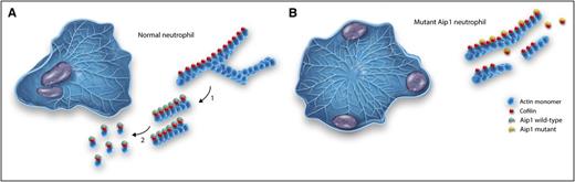 Actin-based motility in a normal and Aip-1 mutant neutrophil. (A) A normal neutrophil polarized after exposure to a chemoattractant (placed in the top right corner). The lamellipodia to the right is filled with dendritic (branched) networks of actin filaments. The actin filaments are magnified to the right. In step 1, cofilin binds to the actin filaments and breaks apart the dendritic networks, leaving long actin filaments. In step 2, activation by Aip1 results in efficient severing and complete disassembly of actin filaments. (B) A mutant Aip1 neutrophil. A dense network of actin filaments is found throughout the cell, preventing effective polarization or directional amoeboid movement. The nuclei are pushed to the periphery of the cell. Note in the magnified view that the actin filaments remain intact. The amount of mutant Aip1 protein is decreased and the reduced amounts of mutant protein fail to activate cofilin. Professional illustration by Somersault18:24.