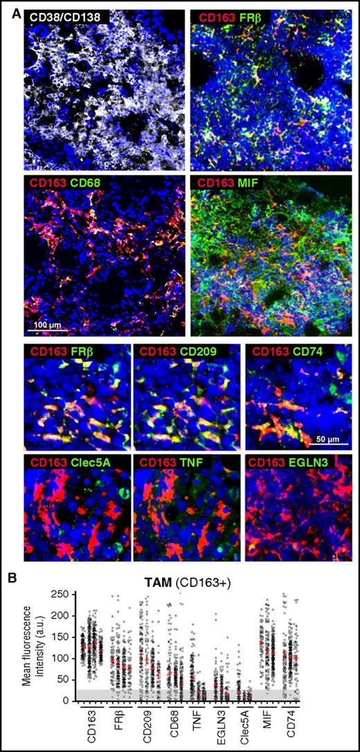 Figure 3. Phenotyping of MM-MØ from BM patient samples. (A) Multicolored staining of BM aspirates containing particles from active disease MM patients, CD38/CD138 (white), CD163 (red); FRβ, CD68, MIF, CD209, CD74, Clec5A, TNF, EGLN3 (green), as indicated. Upper panels represent panoramic views, whereas bottom panels are magnified ones. Nuclear 4′,6-diamidino-2-phenylindole (DAPI) appears in blue in all cases. (B) Plot showing the MFI for each marker in CD163+ TAM (n = 10 cases). Cells > 25 arbitrary units (a.u.) are considered positive, relative to negative control. Scale bars as indicated.
