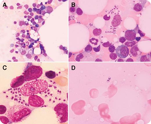 A 61-year-old man presented with fever, night sweats, weight loss, fatigue, and pancytopenia. Four years earlier, he had been treated with chemo/radiotherapy for colon cancer. Diagnostic procedures, including bone marrow aspiration, ruled out cancer relapse, but the cause of his symptoms remained unclear. The patient’s primary care physician prescribed steroid therapy for 3 weeks. On admission, splenomegaly of 15 cm, pancytopenia (hemoglobin concentration, 9.1 g/dL; leukocytes, 1.1 × 109/L; thrombocytes, 68 × 109/L), hypoalbuminemia, and polyclonal hypergammaglobulinemia were present. Bone marrow aspiration was repeated. The smear stained with May-Grünwald-Giemsa stain showed numerous intracellular and extracellular Leishmania amastigotes (panel A, Leishman-Donovan bodies, original magnification ×400; panel B, original magnification ×800), with nucleus and kinetoplast (panel C, original magnification ×1000, detail). High serologic titer and polymerase chain reaction confirmed the diagnosis of visceral leishmaniasis caused by Leishmania donovani. The patient was treated with liposomal amphotericin B, with subsequent recovery. Retrospectively, the presence of rare extracellular amastigotes was detected in the first bone marrow smear before steroid therapy (panel D, original magnification ×1000, detail). / Visceral leishmaniasis is a parasitic infection caused by various Leishmania species transmitted by sandflies. Hematogenous dissemination is well described in immunosuppressed patients, even years after the initial infection. Patients living in (as in our case) or traveling in areas of endemicity should be screened for Leishmania in the presence of pancytopenia, fever, splenomegaly, and hypergammaglobulinemia. Visceral leishmaniasis is endemic in Southeast Asia (L donovani), East Africa (L donovani), North Africa (L infantum), South America (L chagasi), and the Mediterranean basin and the Middle East (L infantum, L donovani, L tropica). More than 90% of cases, according to the World Health Organization, occur in 6 countries: Bangladesh, Brazil, Ethiopia, India, South Sudan, and Sudan.