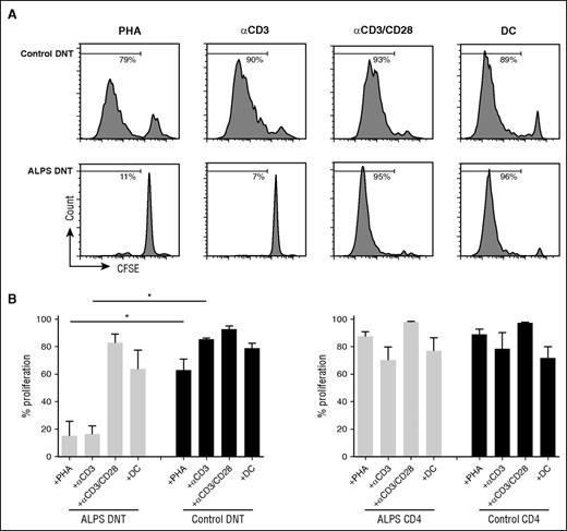 Figure 2. Proliferation of ALPS DNT cells can be induced by costimulatory signals in vitro. Sorted DNT cells (A, B) or CD4+ T cells (B) from patients with ALPS or healthy controls were labeled with CFSE and stimulated with PHA, anti-CD3, anti-CD3/CD28, and allogeneic DC in the presence of IL-2. Cell proliferation was determined on day 6, dead cells were excluded by 7AAD staining. (A) Histograms show 1 representative experiment, (B) graphs represent cumulative data (mean ± SD) of 5 patients with ALPS and healthy controls. *P < .05 (Mann-Whitney U test).