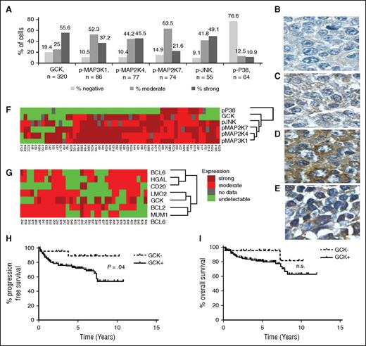 Figure 2. GCK and its downstream effectors are upregulated in de novo primary DLBCL, in a subtype-independent manner. (A) Summary of IHC results from primary DLBCL tumors. Representative staining for GCK negative (B), moderate (C), and strong (D) expressing de novo primary DLBCL tumors. (E) A noncancerous lymph node stained for GCK expression. (F) Fifty-seven primary DLBCLs were analyzed by IHC for GCK, pMAP3K1, pMAP2K7, pMAP2K4, pJNK, and pP38, and (G) 36 primary DLBCLs were stained for GCK, the germinal center markers BCL6, CD10, HGAL, and LMO2, and the ABC-like markers BCL2 and MUM1. Tumor samples were clustered with Cluster software and visualized with Treeview. Kaplan–Meier plots of (H) PFS (P = .04) and (I) overall survival of 151 DLBCL patients treated with R-CHOP grouped on the basis of IHC staining for GCK. The positive cases including GCK medium (n = 33) and high expressing cases (n = 98) were analyzed together. n.s., results that are not statistically significant.