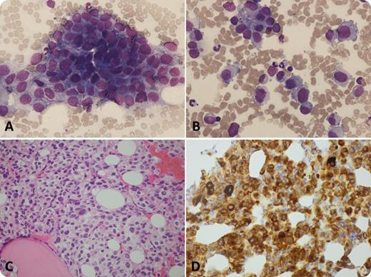 A 79-year-old female presented with weight loss and vomiting. Physical examination was normal other than cachexia. A disseminated malignancy was suspected. A positron emission tomography/computed tomography (PET/CT) scan showed extensive fluorodeoxyglucose uptake in enlarged lymph nodes and lesions in the lung, liver, bone, brain, and breast. Thrombocytopenia and a leucoerythroblastic blood film suggested bone marrow infiltration. The bone marrow aspirate showed infiltration by nonhematopoietic cells (panels A and B; original magnification ×10 and ×40, respectively). The cells were large with an eccentric nuclei and abundant, pale cytoplasm with vacuoles. The trephine biopsy (panel C; original magnification ×40) was infiltrated by pleomorphic cells arranged in loose, discohesive sheets containing a moderate amount of cytoplasm and prominent nucleoli. There was no visible melanin pigment. The clinical history and PET/CT pointed to either a disseminated lymphoma or epithelial malignancy. However, immunohistochemistry for CD45, lymphoid markers, and pancytokeratin was negative. Further immunohistochemistry revealed that the cells were positive for CD117, S100p, HMB45, and Melan A (panel D; original magnification ×40). Hence, a diagnosis of amelanotic melanoma was made. No skin lesion was identified. The patient deteriorated and died 2 weeks after diagnosis. / Melanoma affecting the bone marrow is rare. In the absence of an obvious skin lesion and the lack of melanin pigment, the diagnosis can easily be overlooked.