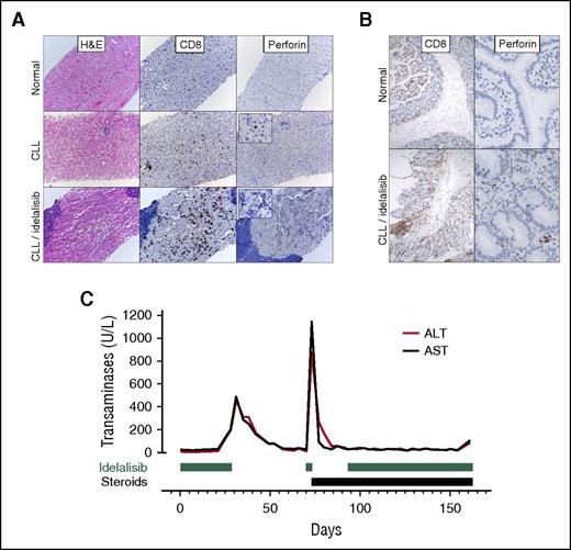 Figure 3. Tissue biopsies and response to steroids suggest an immune-mediated cause for hepatotoxicity. (A) Liver biopsy specimens taken from a normal patient, an otherwise healthy patient with CLL, and a subject with persistent transaminitis after discontinuation of idelalisib. Liver biopsy specimens from patients with CLL demonstrate lymphoid aggregates on hematoxylin and eosin staining (composed of CD20+ B cells, data not shown) as well as increased CD3+ T cells scattered throughout the parenchyma that are increased in number and activation (as assessed by perforin staining) in a subject on idelalisib. (B) A duodenal biopsy specimen from a subject with diarrhea on idelalisib reveals an activated (perforin-positive) CD8+ lymphocytic infiltrate, which is not present in a control sample taken from a subject without CLL. (C) Transaminase levels over time for a subject who, after an unsuccessful attempt at idelalisib reintroduction, was successfully reintroduced to the drug while on steroids.