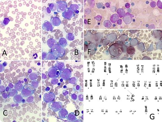 A 23-year-old man with no medical history presented with brutal pain of the lower limbs and night sweats. Complete blood count revealed marked thrombocytopenia with 47 × 109/L platelets, a leukocyte count of 8.74 × 109/L, and a hemoglobin level of 12.9 g/dL. Microscopic observation of a blood smear demonstrated 9% giant blasts (panel A) with an irregular nucleus and cytoplasmic granules. A bone marrow smear revealed a hypercellular marrow with excess blasts (36%) (panel B) and erythrophagocytosis (panels C-D). Cytochemical staining showed strong butyrate and myeloperoxidase activity (panels E-F). Immunophenotyping revealed a high expression of CD13, CD33, CD4, and CD14 but lack of CD34 and CD117, confirming the myelomonocytic lineage. The karyotype was highly suggestive of t(8;16) (panel G), which was verified by fluorescence in situ hybridization analysis, and t(8;16)(p11;p13) with KAT6A/CREBBP fusion was confirmed. / Acute myeloid leukemia (AML) with t(8;16) is a very rare disease (<1% of AML) that is found in both children and adults, with a female predominance and often a history of solid tumor or hematologic disease. This case illustrates the importance of recognizing these blasts characterized by erythrophagocytosis together with myeloperoxidase and butyrate positivity. These features should prompt exploration of t(8;16) KAT6A/CREBBP, which is associated with a poor prognosis, except in neonates, where it can be spontaneously resolutive.