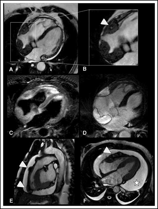 Figure 1. Myocardial and pericardial involvement in ECD. (A-D) Myocardial lesions. ECD typically affects the myocardium by infiltrating the posterior wall of the right atrium, forming soft tissue density masses with smooth surface, which appear hypointense in b-SSFP sequences (the lesions are framed in A). This b-SSFP hypointense infiltration also develops in the right atrioventricular groove, where it encases the right coronary artery (arrowhead in B). T2w image with signal fat suppression shows that there might be diffuse slight hyperintensity within the soft tissue, which usually corresponds to edema (C). In inversion recovery T1w sequences, late enhancement of the lesional soft tissue likely reflects disease activity/inflammation (dotted lines in D). (E-F) Pericardial lesions. ECD-related infiltration of the pericardium causes soft tissue density nodules arising from the visceral pericardial sheets, in association with pericardial effusion. b-SSFP sequences (E-F) allow optimal visualization of the nodules that appear hypointense as compared with the hyperintense pericardial effusion. Arrowheads indicate soft tissue pericardial nodules in the right ventricle outflow tract (E) and right ventricle free wall (F). The pericardial nodules are associated with conspicuous circumferential pericardial effusion (star in F). (A-D,F) Four-chamber view (a plane that allows comprehensive evaluation of myocardium and pericardium). (E) Sagittal view (the best plane to depict the right ventricle ouflow tract).