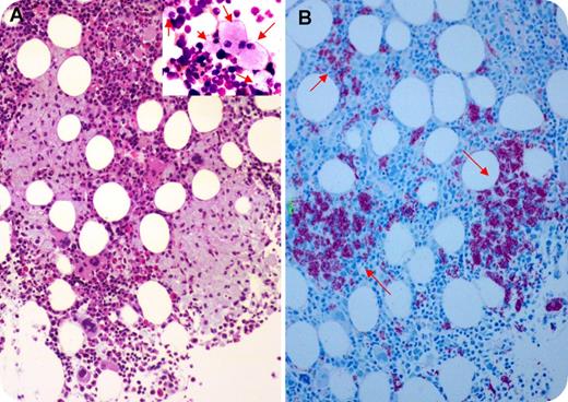 A 61-year-old woman with a remote history of renal transplant was admitted for evaluation of weakness and intermittent cough for the past 3 months and pulsating headache for 1 month. She had diarrhea for several years. She denied experiencing fever, night sweats, or weight loss. She was on tacrolimus/mycophenolate/prednisone and ciprofloxacin. She had diffuse lymphadenopathy/splenomegaly and a right lower pulmonary cavitary lesion. Her complete blood cell count illustrated the following: white blood cell count, 2.28 × 109/L; neutrophils, 1.98 × 109/L; hemoglobin level, 72 g/L; and platelets, 76 × 109/L. A diagnosis of posttransplant lymphoproliferative disorder (PTLD) was suspected. Biopsy of the right cervical lymph node showed infiltrate of histiocytes with acid-fast positive bacilli. Marrow aspirate was reactive, with multiple foamy histiocytes (panel A inset; original magnification ×60; May-Grünwald-Giemsa stain). Biopsy demonstrated multiple noncaseating granulomas (panel A; original magnification ×40; hematoxylin and eosin stain) and abundant acid-fast positive bacilli within the histiocytes (panel B; original magnification ×40; Ziehl-Neelsen stain). Morphology, flow cytometry, and immunohistochemistry ruled out PTLD. Cultures of blood, sputum, urine, stool, and marrow were positive for Mycobacterium avium complex (MAC). The patient developed bowel obstruction with pathological proven Mycobacterium ileocolitis and inflammatory pseudotumor. Viral testing, including HIV, was negative. A diagnosis of disseminated MAC infection was established based on the lymph node/marrow laboratory and clinical findings. The patient was treated with antimycobacterial therapy. / Marrow granuloma is an uncommon finding but can occur in post–renal transplant patients on immunosuppressive therapy with MAC infection.