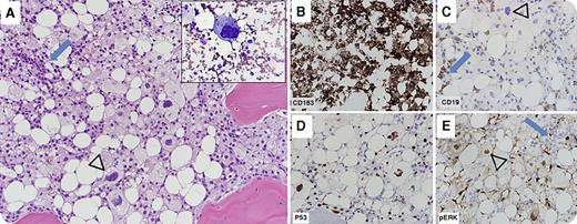 A 22-year-old woman diagnosed with Philadelphia chromosome-negative B-acute lymphoblastic leukemia (B-ALL) was treated with hyperfractionated cyclophosphamide, vincristine, doxorubicin, and dexamethasone therapy. She achieved complete remission and was maintained on 6-mercaptopurine, vincristine, methotrexate, and prednisone therapy. She relapsed 14 months later and was reinduced. She presented to our hospital shortly thereafter, at which time bone marrow evaluation showed persistent B-ALL (blue arrows) admixed with an extensive infiltrate (arrowheads) of intermediate to large neoplastic cells with foamy cytoplasm, pleomorphic nuclei, and prominent nucleoli (panel A, original magnification ×20; hematoxylin and eosin stain; inset, Wright-Giemsa stain; inset and all other panels, original magnification ×40), positive for the histiocytic/monocytic marker CD163 (panel B) and negative for CD19 (panel C). Next-generation mutation analysis showed NRAS (c.35G>A/p.G12D) and TP53 (c.839G>T/p.R280I) mutations; these were associated with p53 accumulation (panel D) and phospho-p44/42 MAPK (Erk1/2) (Thr202/Tyr204) overexpression (panel E) in the histiocytic sarcoma cells. 18-Fluorodeoxyglucose–positron emission tomography/computed tomography (18FDG-PET/CT) showed widespread disease. The patient was treated with ifosfamide, carboplatin, and etoposide followed by clofarabine, idarubicin, plus cytarabine salvage therapy. Subsequent bone marrow evaluation and 18FDG-PET/CT imaging showed resolution of prior findings. The patient died from disseminated Fusarium infection during preparation for allogeneic stem cell transplant. / Histiocytic sarcoma is a rare aggressive neoplasm that may arise as a secondary malignancy, occasionally as a transdifferentiation phenomenon, in conjunction with B-ALL and other lymphoid malignancies.