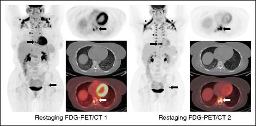 Figure 1. This case illustrates a discrepancy between the revised Lugano Classification (PD) and the immune-related response criteria (PR) given the fact that the immune-related response criteria do not take into consideration PET/CT findings. This type of discrepancy is particularly notable in cases with bone marrow involvement. Oftentimes, lymphomatous involvement of the bone marrow is either not measurable (due to absence of soft tissue component) or imperceptible on CT. Therefore, these findings cannot be integrated in the tumor burden of the immune-related response criteria. Restaging PET-CT is at 12 weeks. Restaging PET/CT 2 at 20 weeks demonstrates new areas of FDG uptake in the left side of T9 vertebral body (arrows) and increasing uptake in the left acetabulum, suggesting increasing extent of marrow disease, whereas this is barely seen on CT. Marked physiologic uptake is also seen in brown fat (asterisks).