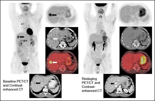 Figure 2. Restaging FDG-PET/CT and contrast-enhanced CT at 19 weeks demonstrates interval resolution of FDG uptake in a liver lesion. Restaging contrast-enhanced CT shows interval decrease in size of the hepatic lesion (arrow). Because the lesion did not disappear, this patient achieved a PR by immune-related response criteria, whereas the absence of FDG uptake on FDG-PET/CT is a CR by the Lugano Classification. There was also a complete metabolic response in the mediastinum and right upper abdomen (asterisks).