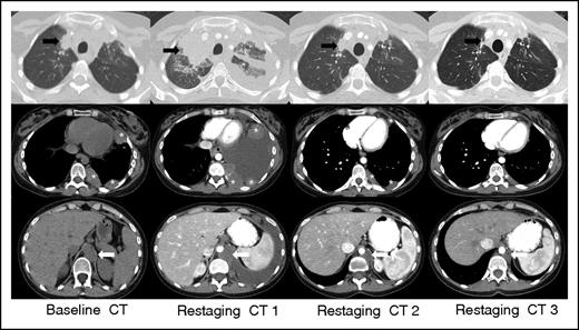 Figure 3. IR(1): Restaging CT 1 at 3 weeks demonstrates overall progression of tumor burden (SPD +124% from baseline) as evidenced interval increase in a right upper lobe lung mass (black arrow), left-sided pleural masses (asterisks), and left retrocrural lymphadenopathy (white arrow), and interval development of a large left-sided pleural effusion. Subsequent follow-up at 7 weeks (restaging CT 2) shows an interval decrease in size of all lesions with resolution of the left pleural effusion (SPD −27% from baseline). Additional follow-up at 13 weeks (restaging CT 3) demonstrates a further interval decrease in tumor burden, and the patient achieved a PR by revised response criteria (SPD −54% from baseline) with clear subsequent clinical benefit from continued treatment.