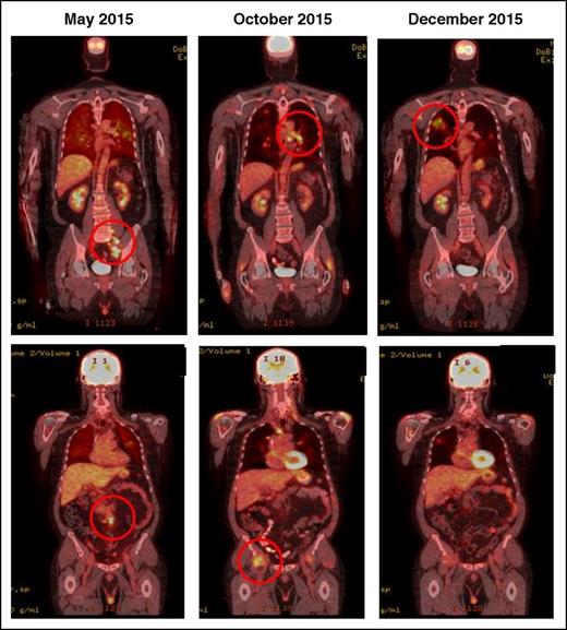 Figure 4. IR(2): CT demonstrating pseudo-progression in a patient on nivolumab for Hodgkin lymphoma. May 2015, pretreatment, October and December 2015 shows transient flares in different nodal groups without overall progression in the original target lesions.