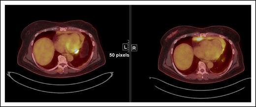 Figure 5. IR(3) showing an increase in FDG uptake in a paracardiac node suggestive of lymphoma without a concomitant increase in size of lesion(s) that meets PD criteria.