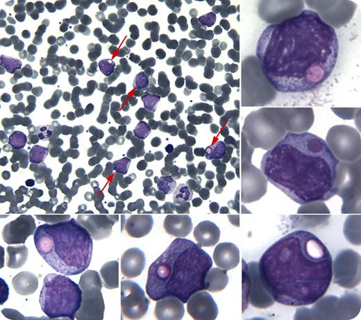 A 27-year-old woman presented with multiple red to violaceous dermal nodules on the scalp, abdomen, and external genitalia, and masses in the left breast. A skin biopsy specimen obtained from her left abdomen was suggestive of myeloid sarcoma. A complete blood count showed 40% blasts. Many of the blasts had giant azurophilic granules, some vacuolated, so-called pseudo Chediak-Higashi anomaly (see arrows within the main panel, and the smaller subpanels). Flow cytometry immunophenotypic analysis on blood showed 46% blasts positive for CD4, CD11c, CD33, CD34, and CD64 and negative for myeloperoxidase, CD13, CD117, and lymphoid markers, supporting a monoblastic/monocytic lineage and the diagnosis of acute monoblastic leukemia (FAB M5). Bone marrow showed acute monoblastic leukemia, and many blasts had pseudo Chediak-Higashi anomaly; conventional cytogenetics were normal, and the NPM1 mutation was present. The patient received chemotherapy and underwent complete remission. / The pseudo Chediak-Higashi anomaly has been reported in acute myeloid leukemia, chronic myeloid leukemia, and myelodysplastic syndromes. Two mechanisms have been suggested for pseudo Chediak-Higashi anomaly: fusion of Golgi-derived or primary granules, or fusion of granules with cell organelles forming a giant autophagic granule. The pathophysiology of pseudo Chediak-Higashi anomaly is unknown.
