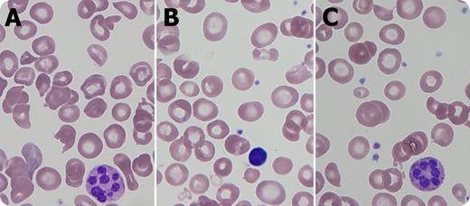 A 7-month-old boy with a history of necrotizing enterocolitis and developmental delay was admitted for anemia (hemoglobin 4.8 g/dL) and thrombocytopenia (platelets 91 × 109/L) with normal white blood cell count (5.4 × 109/L), mean corpuscular volume 90.2 fL, lactate dehydrogenase 757 U/L, and 3+ hemoglobinuria without microscopic hematuria. The blood smear demonstrated hypersegmented neutrophils (panels A,C), macrocytes (panel B), and red blood cell fragments (panels A,C). Serum folate and vitamin B12 were normal, but plasma homocysteine was elevated (>100.0 μmol/L), methionine decreased (10 μmol/L), and methylmalonic acid normal, indicating a specific homocysteine to methionine conversion defect. Fibroblast functional analysis showed reduced 14C methyltetrahydrofolate incorporation, and methionine synthase (MTR) gene sequencing revealed a known pathogenic mutation and a previously unreported mutation affecting splicing. Thus, cobalamin (cbl)G deficiency was diagnosed. / Peripheral blood smear analysis was key in this case, linking microangiopathic hemolytic anemia to a megaloblastic process. This combination of findings is described in pernicious anemia and inborn errors of cobalamin metabolism affecting homocysteine methylation and conversion to methionine, specifically the methylcobalamin deficiencies cblC-G and cblJ. Key considerations in management are betaine and hydroxycobalamin supplementation, as well as thromboprophylaxis for intravascular coagulation attributable to markedly elevated homocysteine levels.