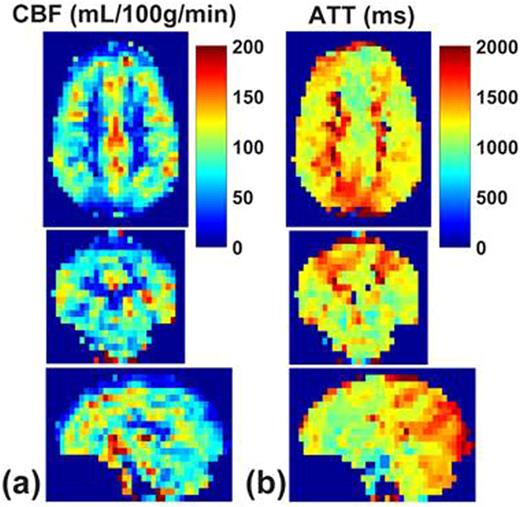 Figure 1. Representative CBF (a) and ATT (b) maps acquired with 3D whole-brain coverage in axial, coronal and sagittal planes.