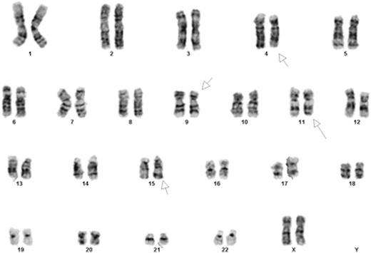 Figure 1. Conventional karyotyping showing 46,XX,t(4;15)(q31;q22),t(9;11)(p22;q23).Chromosome analysis was performed on 20 G-banded metaphase cells from multiple unstimulated cultures. Both translocations were present in all cells examined.
