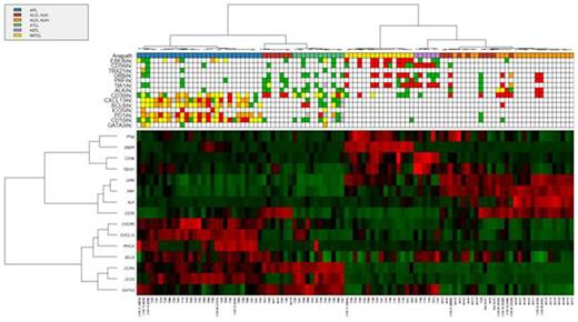 Figure. Prediction of PTCL subgroups using RT-MLPA. The assay was used to differentiate AITL, ALCL, ATLL, HSTL and NKTCL within 101 biopsies. Differential gene expression is depicted according to a red (positive) to green (negative) color scale (lower panel). Concordances with histopathological diagnosis and immunohistochemisty are indicated in the upper panel.