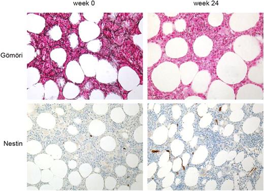 Figure 1. Bone marrow histology of a patient before (week 0) and at the end ofmirabegron treatment (week 24). Upper panel,reticulin fibers are stained black by silver impregnation (Gomori). Lower panel, immunohistochemistry staining with antibodies against humannestin protein (brown staining). Note decrease inreticulin fibrosis and increase innestin+ cells after 24 weeks of treatment. Magnification: 200x.