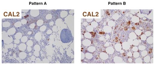 Figure. Immunohistochemical patterns of CAL2 staining in ET samples: megakaryocytes only (pattern A) or megakaryocytes and myeloid precursors (pattern B).