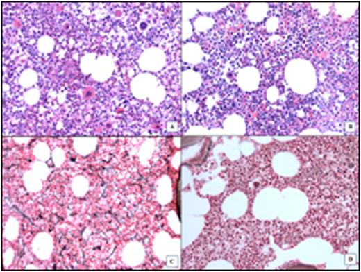 Figure. BM assessment of a PV patient with BM-CR. A & C: Before treatment: increased cellularity and abnormal megakaryocytes number/morphology; MF-2. B & D: After treatment: normocellular BM, normal morphology, MF-0.