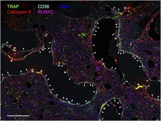 Figure. Visualization of bone-remodeling cells in BM tissue section of a patient with MF. Immunostaining with TRAP and cathepsin K revealsgiant multinucleated osteoclasts (*), while elongated CD56+/RUNX2+ osteoblasts (▾) line along the bone edge. Scale bar: 200 µm.