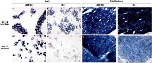Figure 3. G6PD (A, C, E, G) and IDH1 activity (B, D, F, H) staining of IDH1WT (A, B, E, F) and IDH1MT (C, D, G, H) primary AML cells (A-D) and glioblastoma (E-H) cryostat sections. The amount of blue color directly reflects enzyme activity (production of NADPH).