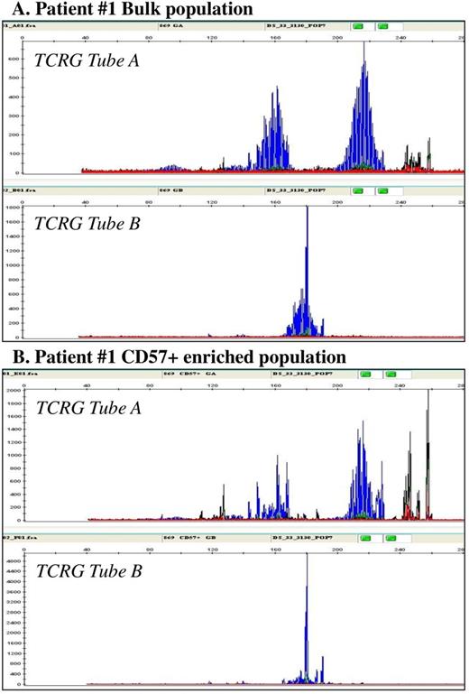 Figure 1. Results of TCRGclonalityassessment for patient #1 with polyclonal pattern in bulk population (A) and monoclonal pattern in CD57+ enriched lymphocyte population (B).